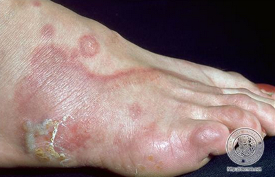 手足癣是最常见的浅部真菌病,是由于特定种类的真菌感染手足部皮肤