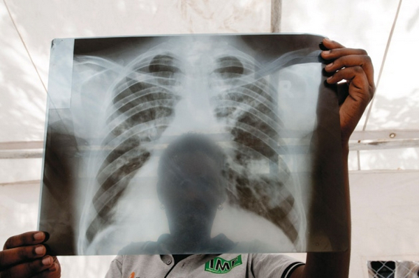 乌干达里拉市一名结核病人的胸部x光片.