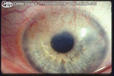 角膜周边血管翳.copyright @ online journal of ophthalmology
