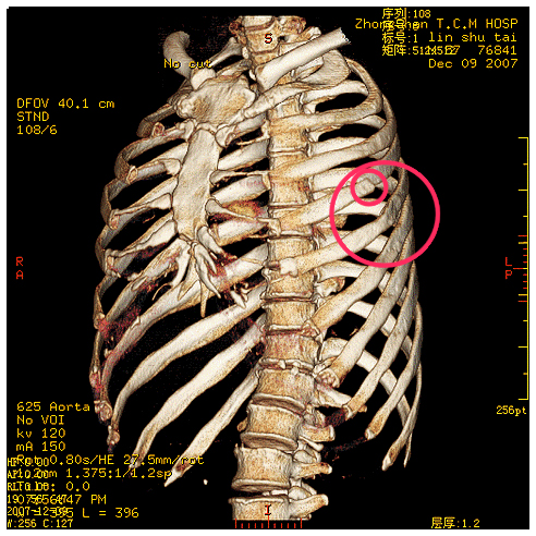 三维重建的图像,诊断为"左侧第4肋骨后段及第4-6肋骨腋段骨折(图中